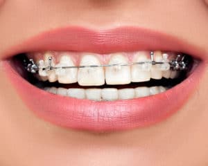 clear braces bridgewater nj