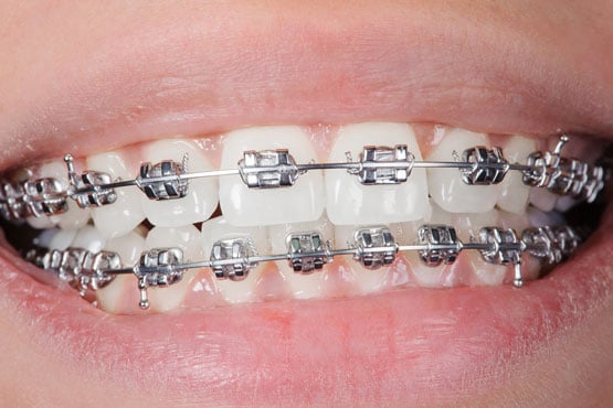 Traditional Braces in Bridgewater, NJ