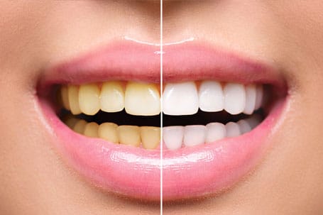 Teeth Whitening in Martinsville, NJ