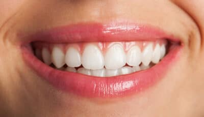 Teeth Whitening New Jersey