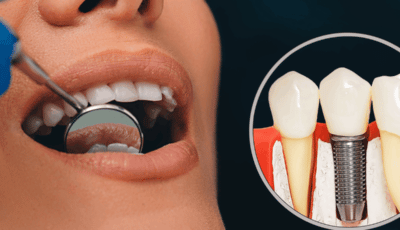 Dental Implants in Bridgewater NJ