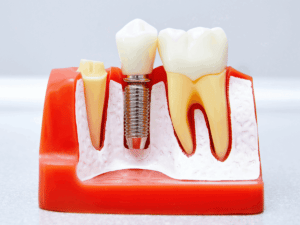 Dental Implants in Bridgewater NJ