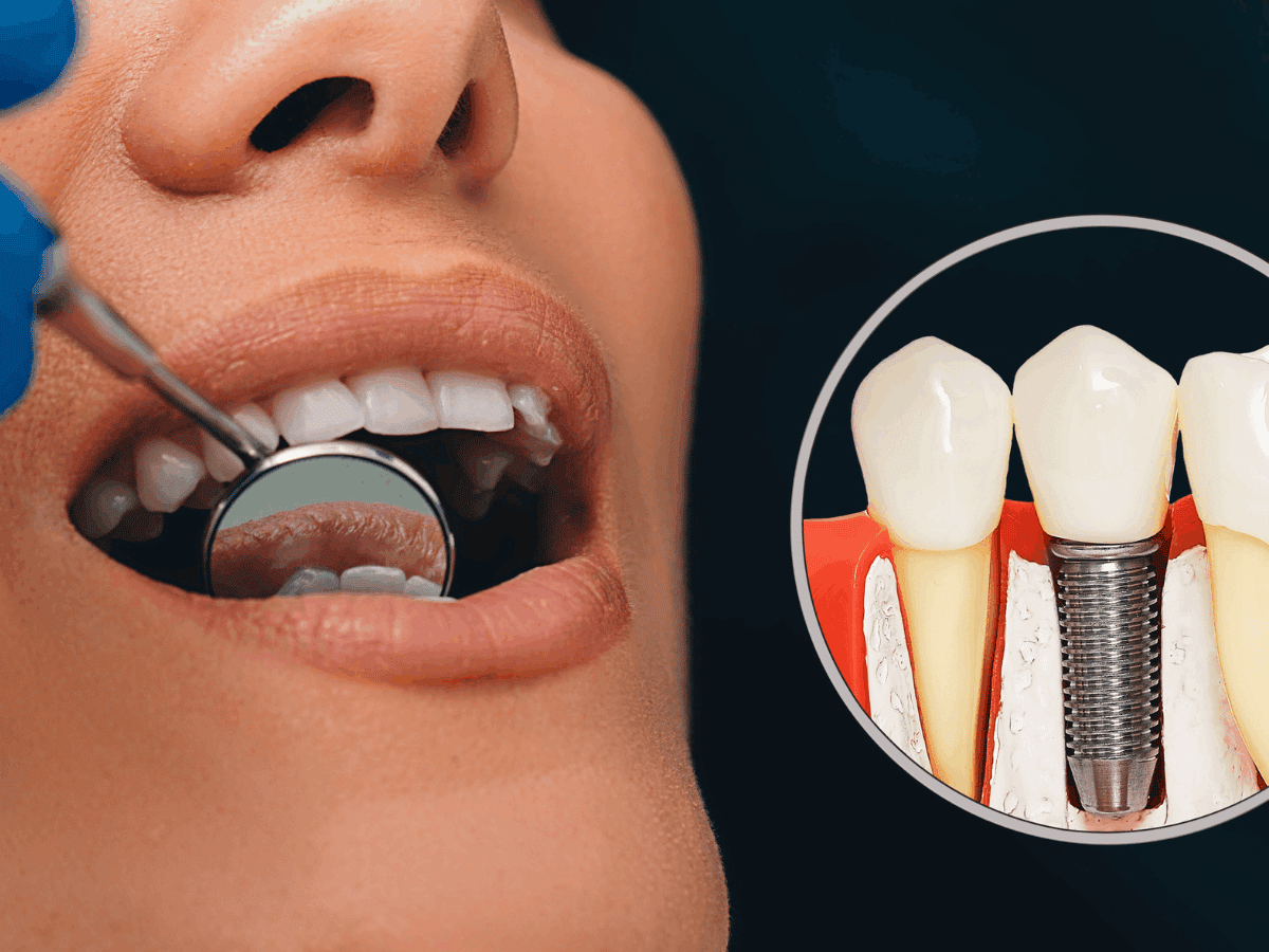 All About Dental Implants in Bridgewater NJ