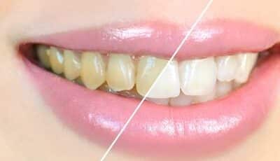 Teeth Whitening in Bridgewater