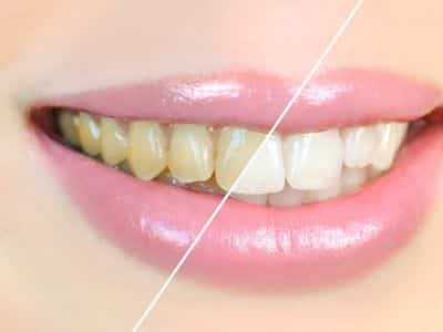 Why You Should Consider Professional Teeth Whitening in Bridgewater 