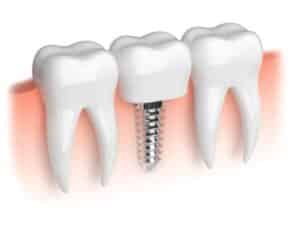 Dental Implants