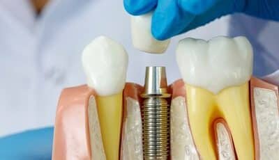 Dental Implants Bridgewater NJ