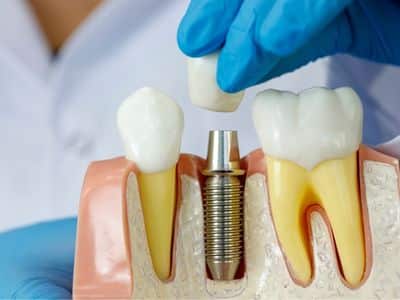 Where Do You Find Dental Implants in Bridgewater, NJ?